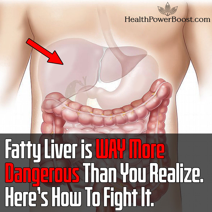 Fatty Liver is WAY More Dangerous Than You Realize