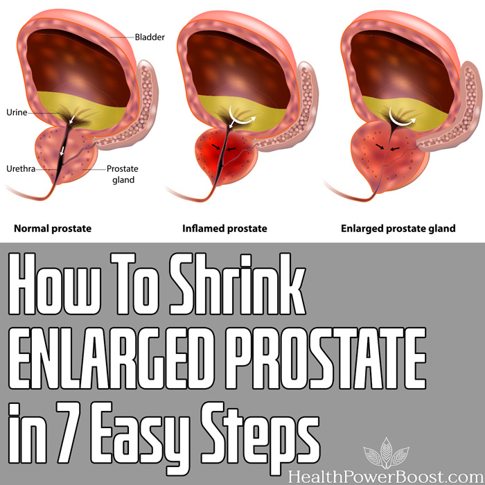 How To Shrink ENLARGED PROSTATE in 7 Easy Steps