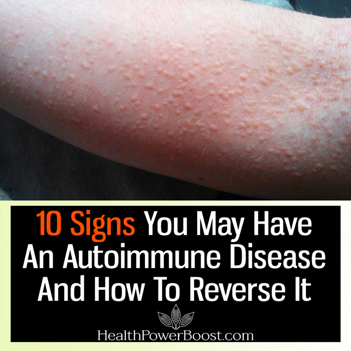 10 Signs You Have An Autoimmune Disease And How To Reverse It