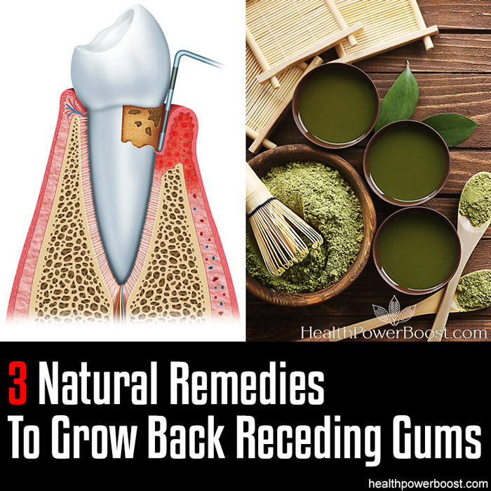 3 Natural Remedies To Grow Back Receding Gums