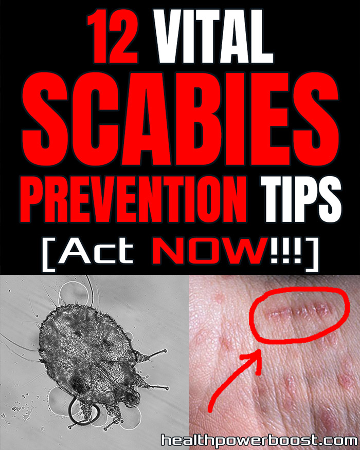 12 SCABIES PREVENTION TIPS